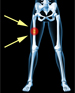 Femur fractures linked to osteoporosis medications | Fosamax | Boniva | Actonel | Aredia | Zometa