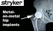 Georgia Stryker Rejuvenate Hip Replacement Recall Lawyer